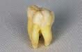 Wisdom Tooth