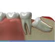 Impacted molar