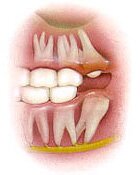 Impacted Wisdom Teeth: Oral surgery by dentist Dr Allan Melnick, DDS