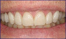 Veneers for chipped teeth are fixed by Encino dentist Dr Allan Melnick