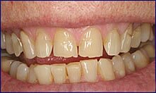 Veneers for chipped teeth are fixed by Encino dentist Dr Allan Melnick