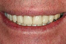 Crown Replacement preformed by Encino dentist Dr Allan Melnick