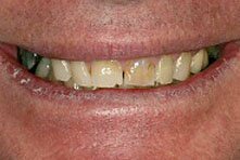 Crown Replacement preformed by Encino dentist Dr Allan Melnick