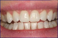 Encino Dentist Dr Allan Melnick does professional tooth whitening