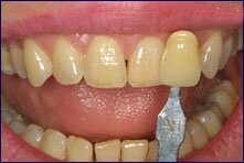 Encino Dentist Dr Allan Melnick does professional tooth whitening