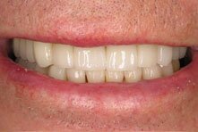 After Smile Makeover