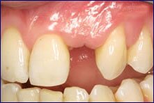 Single Tooth Implants done by Encino dentist Dr Allan Melnick