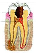 Impacted Wisdom Teeth: Oral surgery by dentist Dr Allan Melnick, DDS