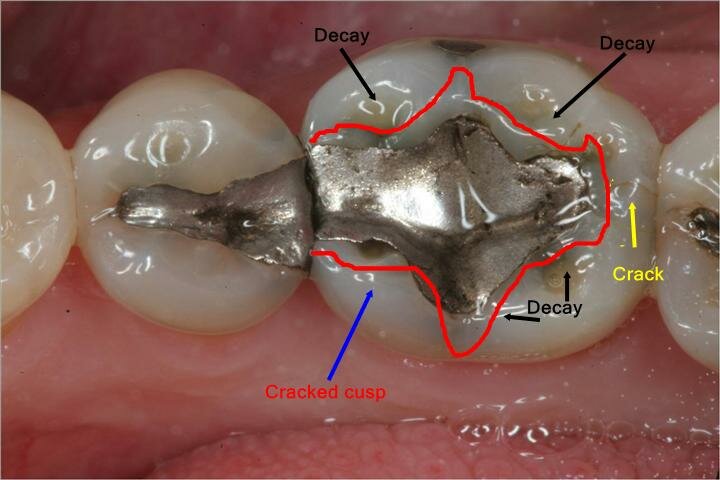 Broken and decayed silver-mercury filling needing care shown on Intra-oral camera.