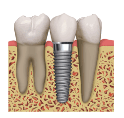 Dental Implants are done by Encino dentist Dr Allan Melnick, DDS