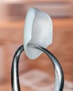 Lumineer veneers done by Dr Allan Melnick