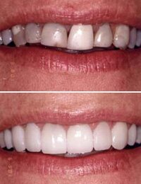 Encino Family dentist Dr Allan Melnick helps Stephanie's new smile makeover