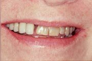 Before dentist Dr Allan Melnick, DDS added Porcelain Veneers to these teeth