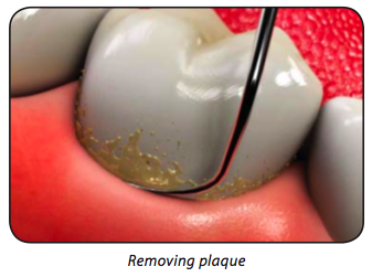 Preventive dentistry in Encino with Dr Melnick