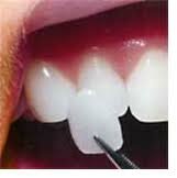 Porcelain veneers being placed.