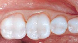White Fillings can be put in by dentist Dr Allan Melnick in Encino, CA